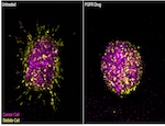 3D spheres of cancer cells (purple) and stellate cells (yellow) that have been cultured together in the laboratory. In untreated conditions (left), stellate cells invade into the surrounding tissue, cutting tracks for the cancer cells to follow. When treated with an FGFR inhibitor (right), this invasion is blocked.